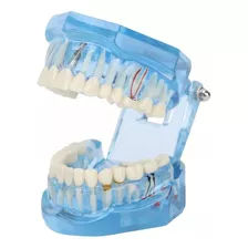 Manequim Modelo Odontológico Dental Implante Prótese.