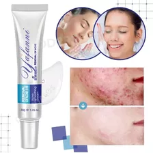 Crema Facial Para Acné Espinillas Control Aceite Antiacne