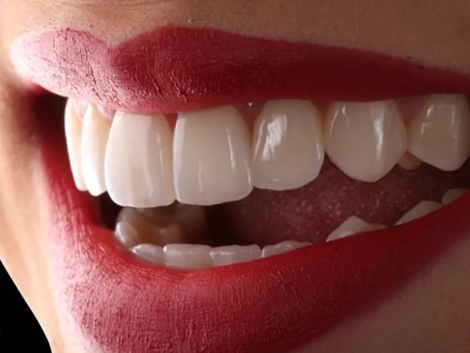 Blanqueamiento Dental Led +limpieza Dental + Fluor 
