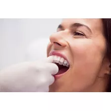 Blanqueamiento Dental Mejor Que Opalescence Go + Limpieza