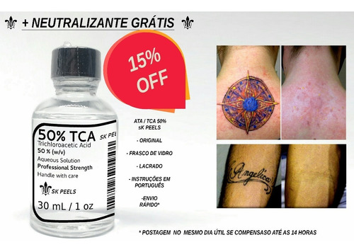 Acido removedor de tatuagem 100 Remocao De Tatuagem Youtube