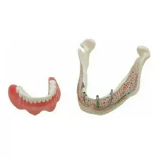 Modelo Manequim Mandibular Protocolo Sobre Implante Dentário