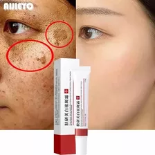 2 Cremes Removedor Melasma Sardas Acne E Manchas