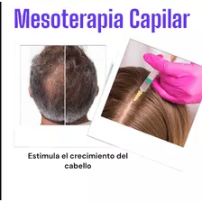 Mesoterapia Capilar!!!