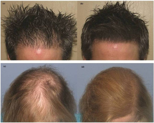 Imagen 2 de 2 de Fibras Capilares Marca Toppik 27,5 Aparenta Mas Cabello Pelo