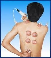 Ventosas Tecnica China Elimina Dolores, Celulitis 12 Copas