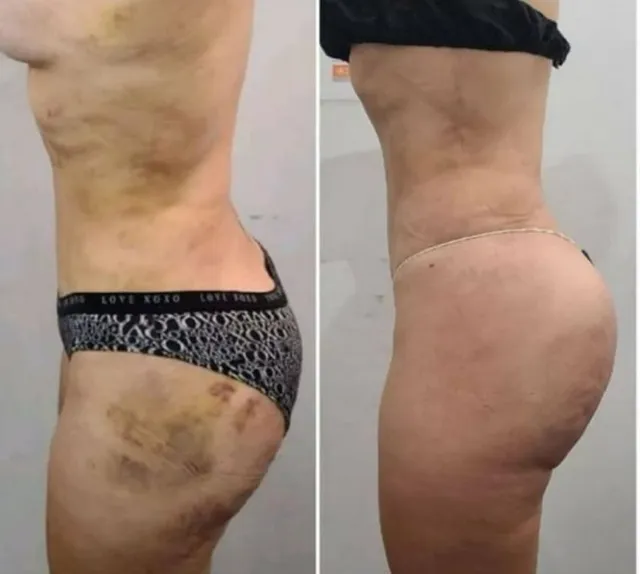 Drenaje Post-quirurgicos  Y Mucho Mas 829-879-6076