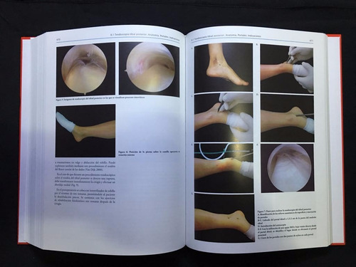 Artroscopia De Tobillo - Bases Y Fundamentos - Jorge Batista