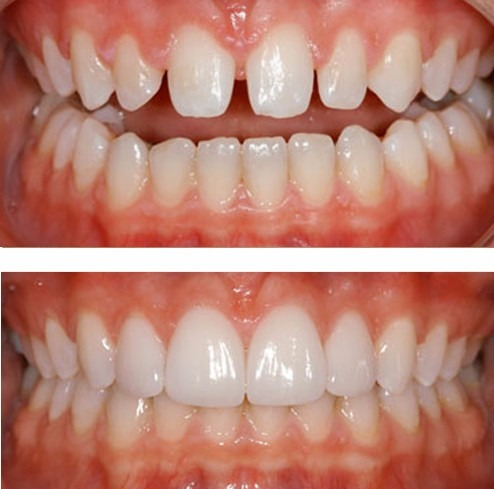 Carillas Dentales Composite Porcelana Belgrano (sin Envio)