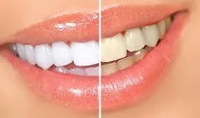 Blanqueamiento Dental Led + Limpieza Dental + Fluor Belgrano