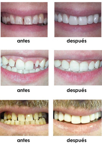 Carillas Dentales Composite Porcelana Belgrano (sin Envio)