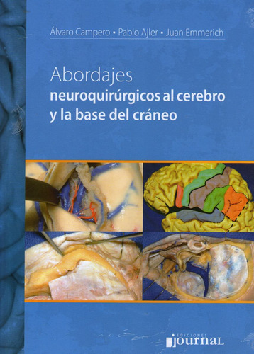 Abordajes Neuroquirurgicos Al Cerebro Y La Base Del Craneo