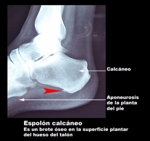 Talonera O Plantillas De Gel Ortopedicas Para Espolon Barata