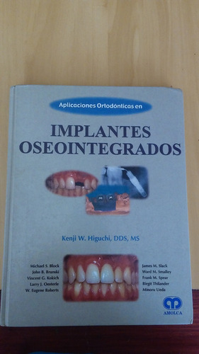 Implantes Oseointegrados