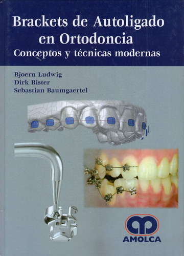 Brackets De Autoligado En Ortodoncia - Ludwig