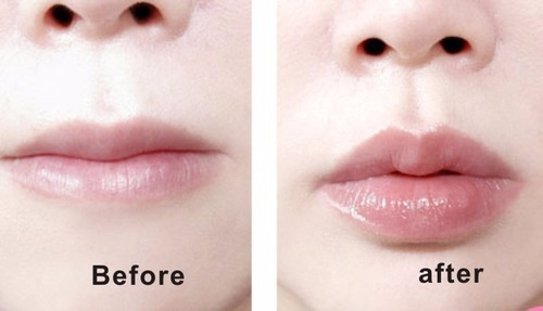 Voluminizador De Labios Aumento Del Volumen Plastico