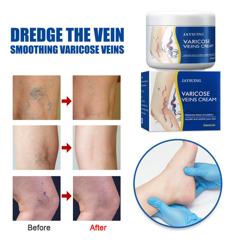 2 × Creme Para Venas Varicosas X Spider Varique Venin Treat