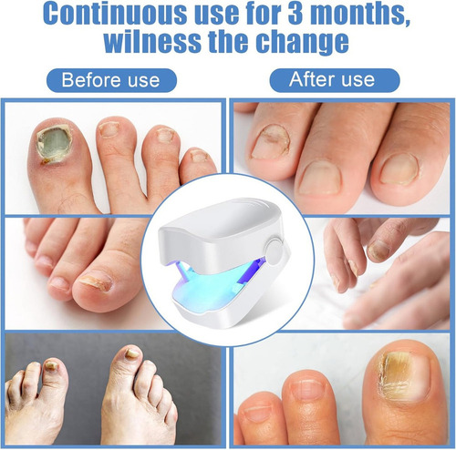 Tratamiento Con Láser Para La Onicomicosis