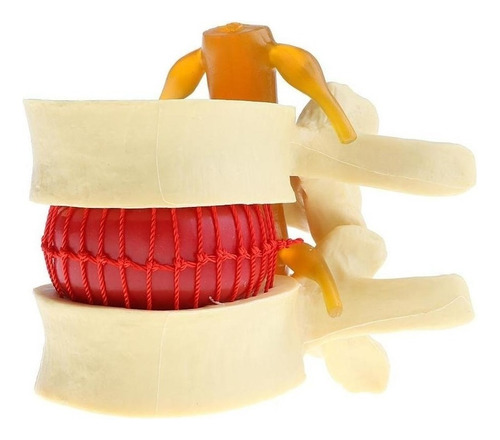 2x Modelo De Hernia De Disco Lumbar De La Columna Vertebral