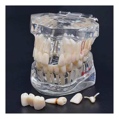 Modelo De Dientes De Enfermedad A Puente De Implante Dental