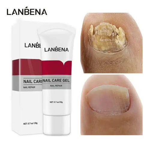 Gel Uñas Onicomicosis Pies Manos Antimicotico Hongos Lanbena