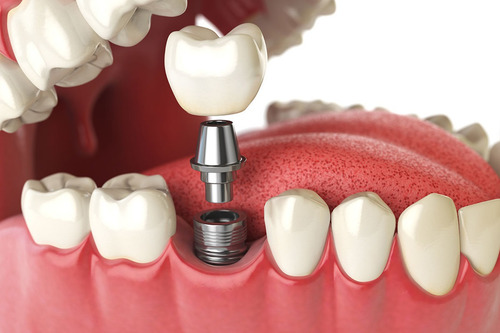 Imagen 2 de 2 de Implante + Abutment + Corona Sobre Implante /osde/medife