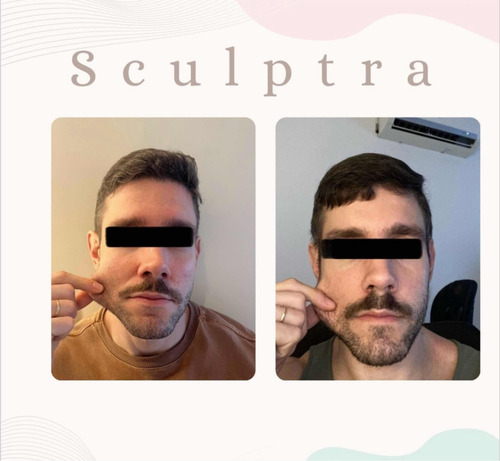 Aplicación De Botox (toxina Botulínica)