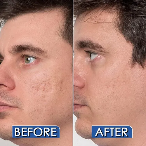 Particle Gel De Silicona Para Cicatrices, Alta Concentración