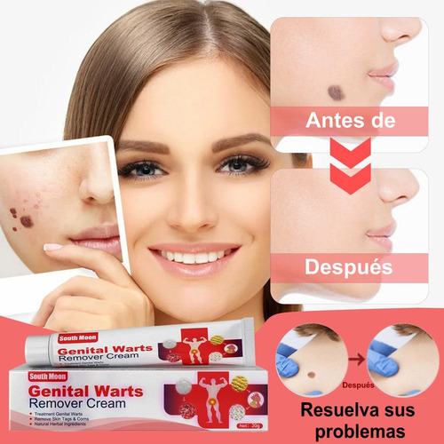5 Piezas Ungüento Removedor Verrugas Del Herpes Genital