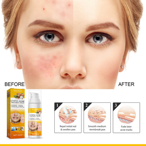 . Crema For Tratar El Acné: Combate El Acné Hormonal