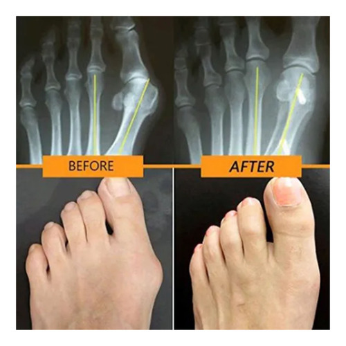 Corrector Ortopédico Juanete Hallux Valgus De Do Del Pie