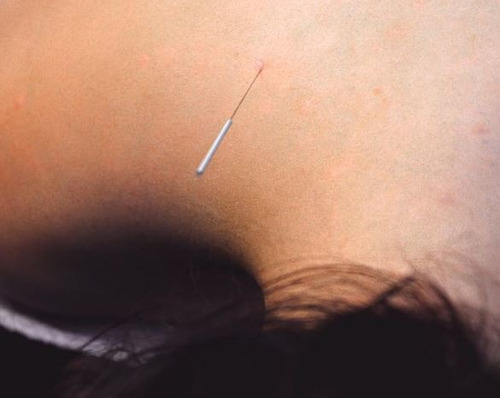 Imagen 4 de 6 de Terapias Alternativas, Medicina Tradicional Y Acupuntura