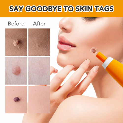 Skin Tag Removal Kit For Face, Neck And Body