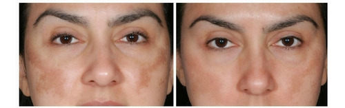 Serum Ac. Hialuronico E Retinol Clareador Manchas