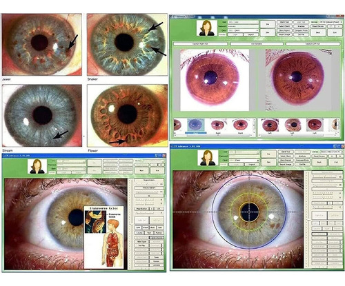 Cámara De Análisis De Iris, Cámara De Iridología Con
