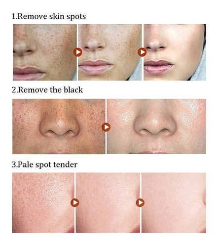 Imagen 5 de 8 de Maquina Pluma Laser Luz Azul Cuidado Facial Acne Cicatrices