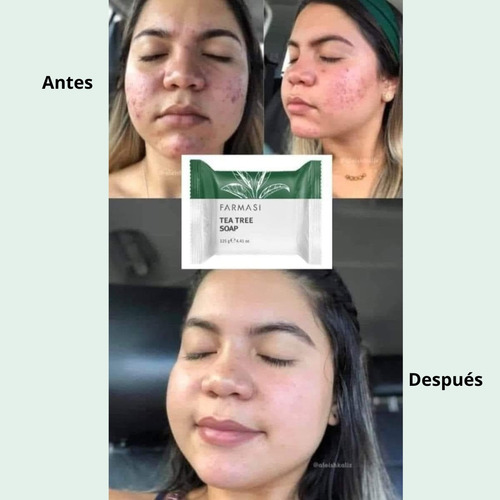 Jabon Tea Tree Farmasi Control De Acne Piel Grasa Y Mixta