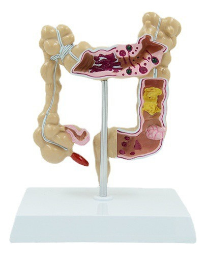 Modelo De Estudio De Patología Del Intestino Grueso Humano 1