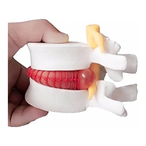 Modelo De Hernia De Disco Lumbar, Aumento De 1.5 Veces Para.