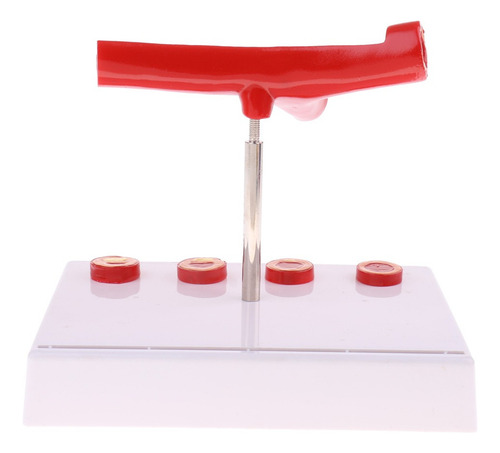 Modelo De Vascular De Trombo De Aterosclerosis De Vaso