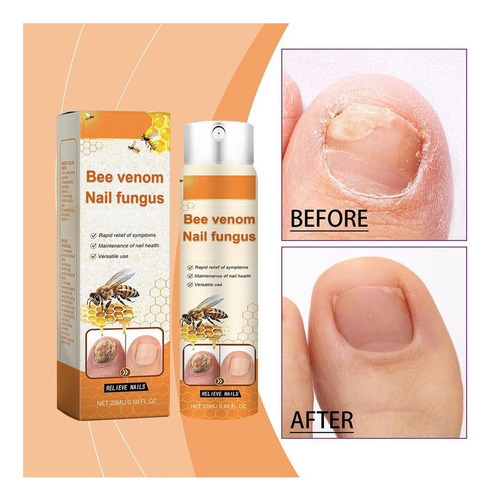 - 2 Sprays Calmantes Para Hongos En Las Uñas De 20 Ml