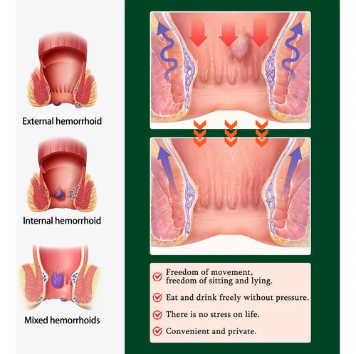 Crema, Pomada, Crema Para Prolapso Del Ano, Fisura Anal
