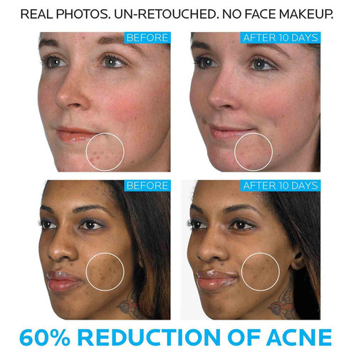 La Roche-posay Effaclar Duo Tratamiento Para Acné 40ml