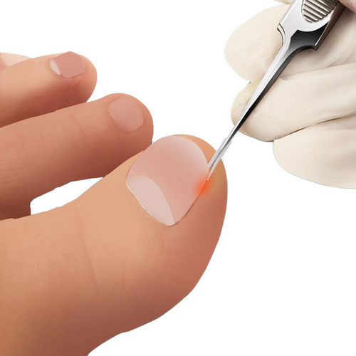 Kit De Tratamiento Para Uñas Encarnadas: Corrector, Levantad