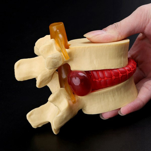 Modelo De Vértebras Lumbares: Columna Anatómica Hernia D