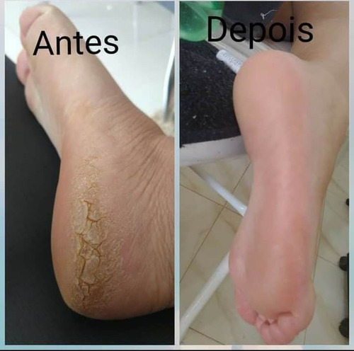 Repos 12 Amaciantes De Cutículas E Calosidades 120ml