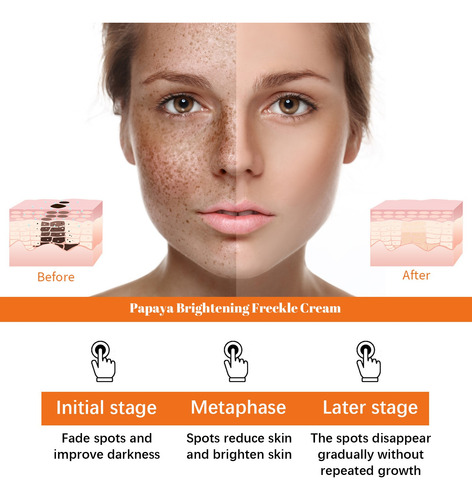 Crema Removedora De Pecas Facial Blanqueadora Y Aclaradora Y