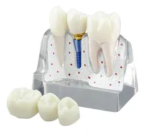 Comprar Modelo Transparente De Implante Dental Para Educación De Pac