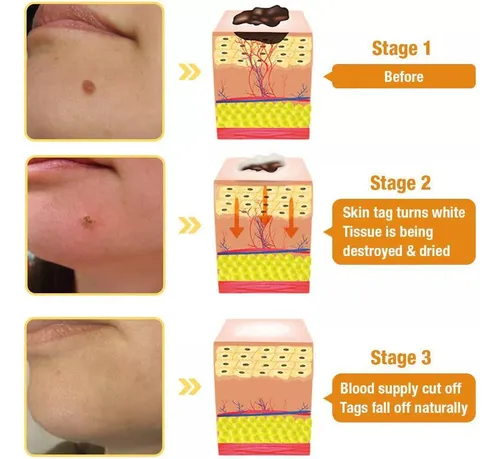 5×crema Para Eliminar Etiquetas Veneno Abeja