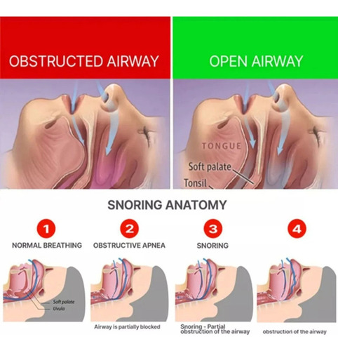 Dispositivos Antirronquidos Solution For Ronquidos Snore, 1